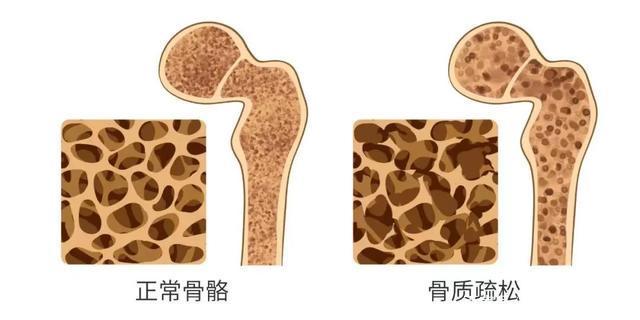 6个不良习惯可能会增加患骨质疏松的风险